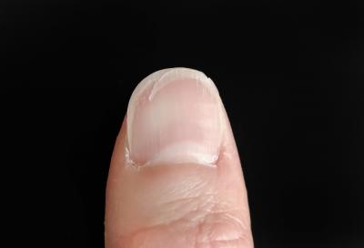 「爪の亀裂は放置しない」気分が落ちるだけじゃない…“爪の補修材”で爪トラブルも防ぐ